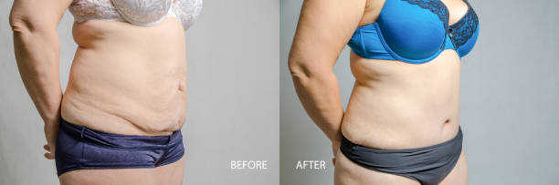 woman before and after her abdominoplasty and liposuction - dieting front view vertical lifestyles imagens e fotografias de stock
