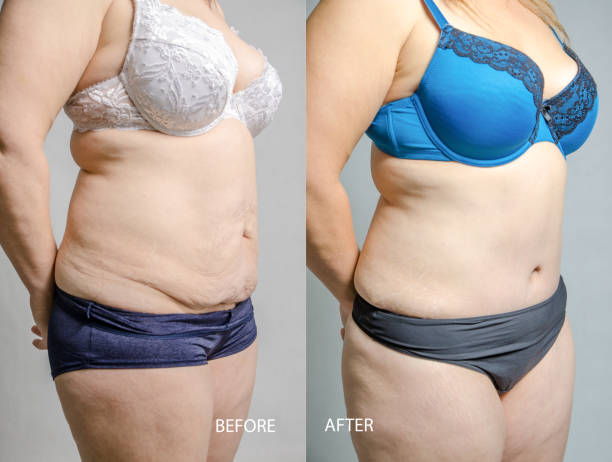 woman before and after her abdominoplasty and liposuction - overweight tummy tuck abdomen body imagens e fotografias de stock