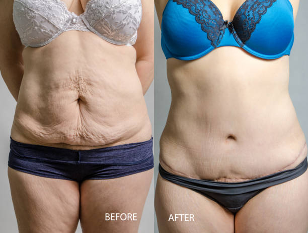 frau vor und nach ihrer bauchstraffung und fettabsaugung - dieting front view vertical lifestyles stock-fotos und bilder