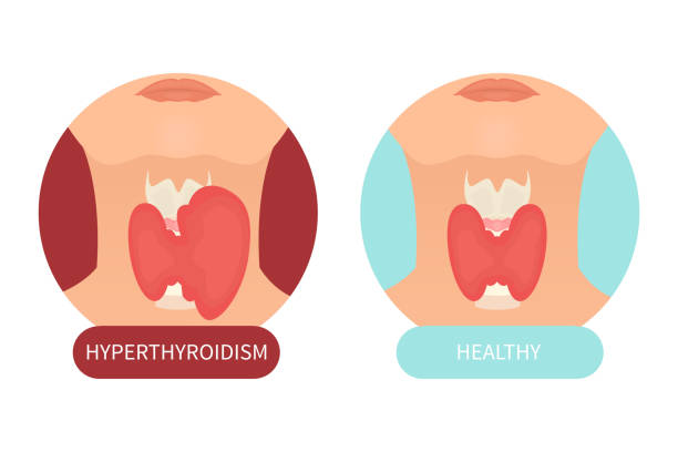 Female healthy thyroid and its disorder Woman with healthy thyroid gland and hyperthyroidism made in cartoon style. Front view sign. Human body organ anatomy icon. Medical concept. Vector illustration made in cartoon style. thyroid gland stock illustrations