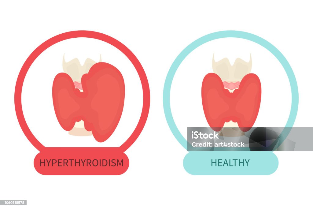 Hyperthyreosis Gland With Healthy Thyroid And Hyperthyroid Disorder Stock Illustration ...
