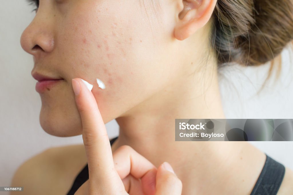Portrait of young Asian woman having acne problem. Applying acne cream on her face. Shot of woman preparing for applying acne cream for solve her problem skin. Acne Stock Photo