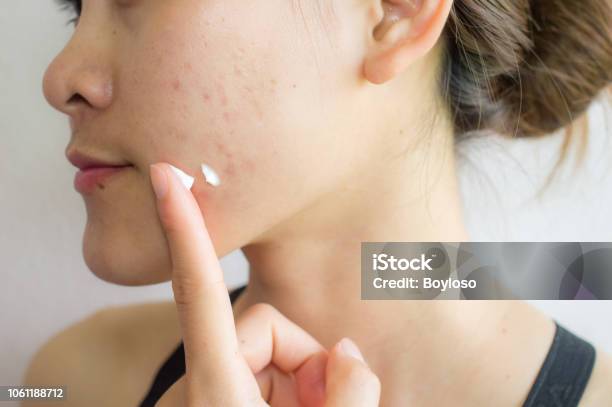 Portrait Of Young Asian Woman Having Acne Problem Applying Acne Cream On Her Face Stock Photo - Download Image Now