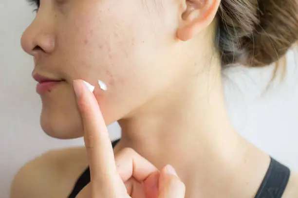 Photo of Portrait of young Asian woman having acne problem. Applying acne cream on her face.