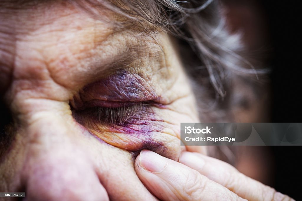 Senior woman touches bruise and winces A cropped close-up of an old woman wincing as she touches her badly bruised face. Elder Abuse Stock Photo