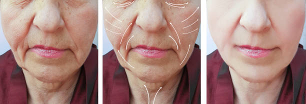 istock face, elderly woman, wrinkles, correction before and after procedures, arrow 1061313546