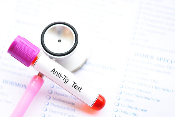 Blood sample for anti-Tg or anti-thyroglobulin test Blood sample tube for anti-Tg or anti-thyroglobulin test, diagnosis for thyroid hormone disease autoantibody stock pictures, royalty-free photos & images