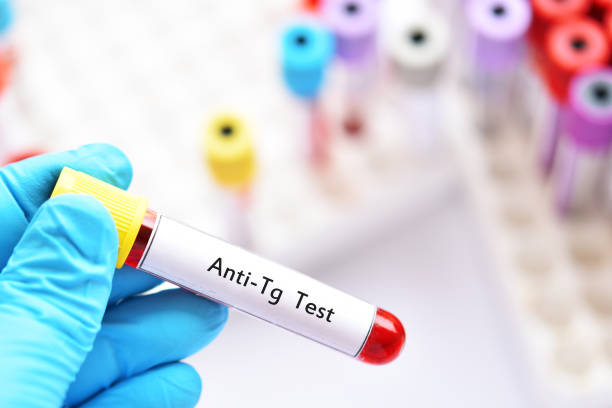 Blood sample for anti-Tg or anti-thyroglobulin test Blood sample tube for anti-Tg or anti-thyroglobulin test, diagnosis for thyroid hormone disease autoantibody stock pictures, royalty-free photos & images