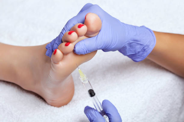 The doctor makes intramuscular injections of botulinum toxinon the feet of a woman stock photo
