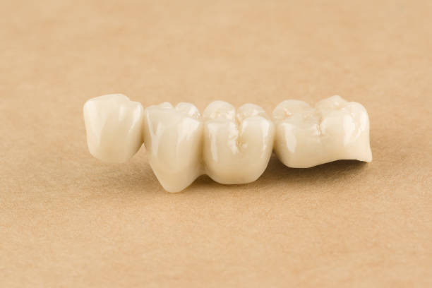 istock cermet dental bridges 1062089452