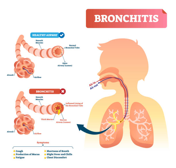 Bronchitis vector illustration. Lung disease diagnosis with symptoms. Bronchitis vector illustration. Lung disease diagnosis. Labeled medical diagram with healthy airway and illness. Pulmonary problem and symptoms like cough, fatigue, breath shortness, chills and fever. bronchitis stock illustrations