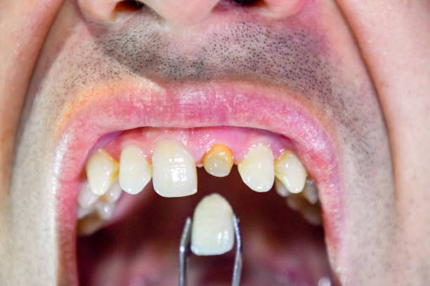 istock Tooth implantation, dental treatment. 1062308618