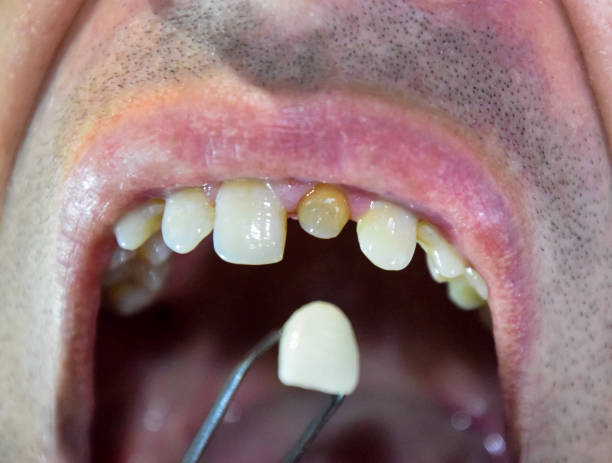 istock Tooth implantation, dental treatment. 1062308622