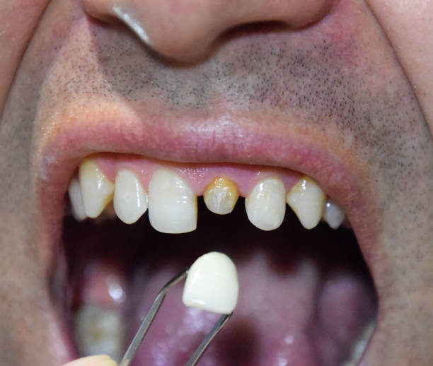 istock Tooth implantation, dental treatment. 1062308624