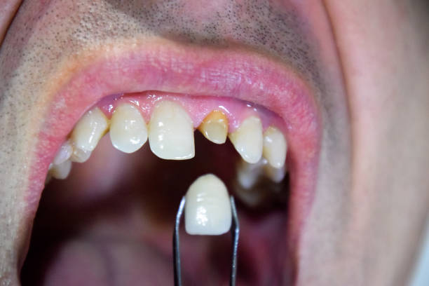 istock Tooth implantation, dental treatment. 1062308634