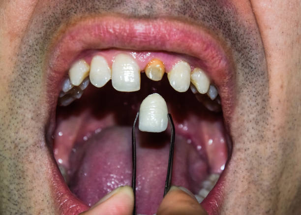 istock patient without a tooth is trying on a denture 1062308666