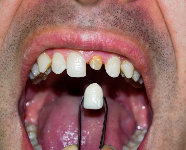 istock patient without a tooth is trying on a denture 1062308698