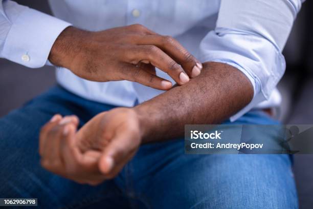 Man Scratching His Hand Stock Photo - Download Image Now - Skin, Scratching, Psoriasis