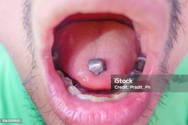 Amalgam Fillings Stock Photo - Download Image Now - Air Pollution, Buccal Cavity, Care