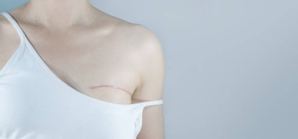 Breast cancer surgery scars Breast cancer surgery scars by partial mastectomy.  She can wear a tube top or tube dress and strapless with confident. With the ​effect filter. breast stock pictures, royalty-free photos & images