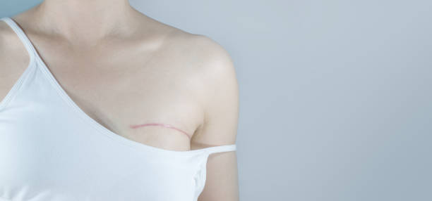 Breast cancer surgery scars Breast cancer surgery scars by partial mastectomy. She can wear a tube top or tube dress and strapless with confident. With the effect filter. scar stock pictures, royalty-free photos & images