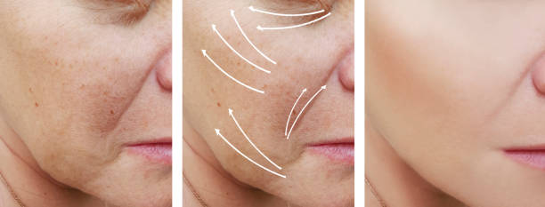 istock woman face wrinkles correction before and after procedures, arrow 1063246714