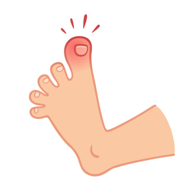 Foot with toe pain Cartoon foot with swollen stubbed toe, pain and trauma vector illustration. toe stock illustrations