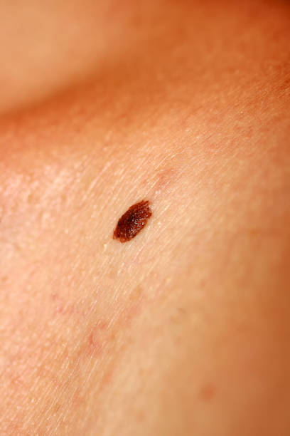 istock Brown birthmark. Brown mole large size. Stain on the skin 1063876224