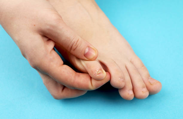 pilz der fuß close-up, isoliert auf blauem hintergrund. der begriff dermatologie, behandlung pilz- und pilz-infektionen beim menschen. makro fotografie menschliche parasiten. hinteren hintergrund eines dermatologen - podiatry chiropody toenail human foot stock-fotos und bilder