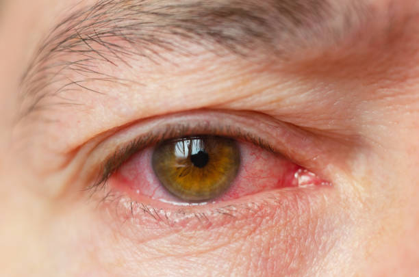 closeup irritated infected red bloodshot eyes, conjunctivitis - inflammation imagens e fotografias de stock