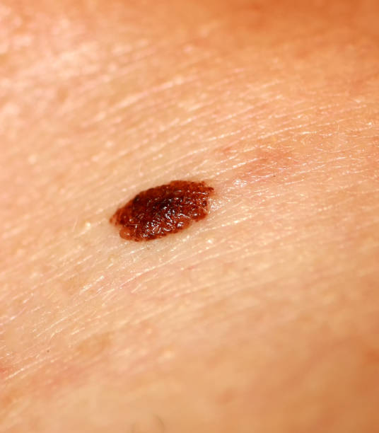 istock Brown birthmark. Brown mole large size. Stain on the skin 1063944886