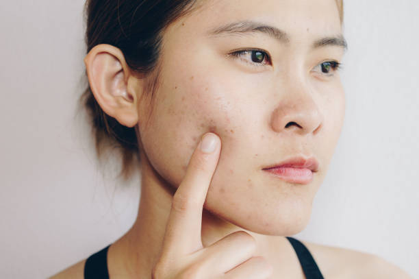 portrait de femme asiatique a des problèmes avec la peau sur son visage. - cheek color photos et images de collection