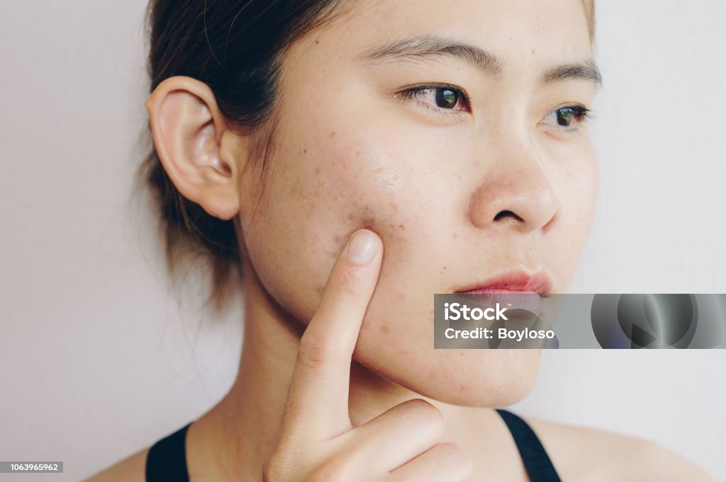 Portrait of Asian woman has problems with skin on her face. Problems with acne and scar on the female skin. Acne Stock Photo