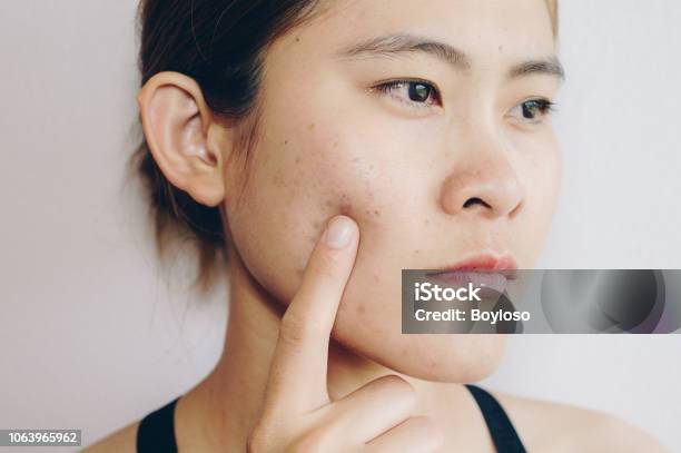 Portrait Of Asian Woman Has Problems With Skin On Her Face Stock Photo - Download Image Now