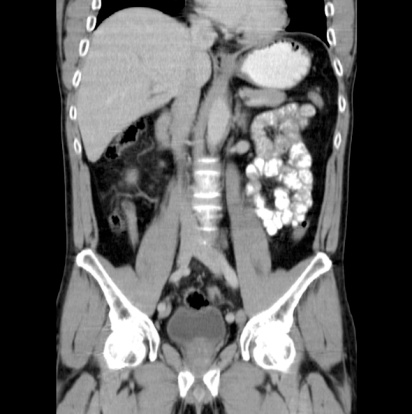 Computed tomography of abdomen.