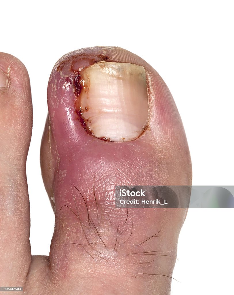 Ingrowing toe-Nägel. Makro Foto. - Lizenzfrei Bildkomposition und Technik Stock-Foto