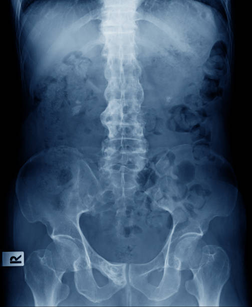 x-ray image of old man show ankylosing spondylitis or bamboo spine stock photo
