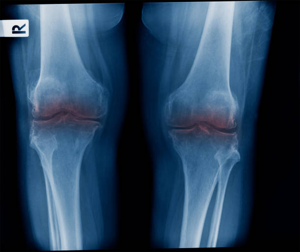 istock x-ray OA knee both knee in blue tone 1064228504