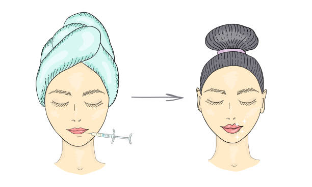 The girl s face with hair gathered in a bun and a syringe in her lips. Lip augmentation with hyaluronic acid. Before and after. The girl s face with hair gathered in a bun and a syringe in her lips. Lip augmentation with hyaluronic acid. Before and after. Vector color illustration drawn by hand. big fat lips stock illustrations