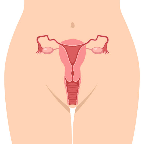 lůno - endometritida ilustrace stock ilustrace