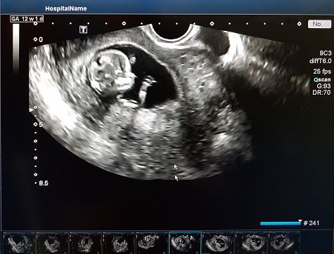 Photos of the child in the 12 week of pregnancy. Ultrasound procedure. Screening in the first trimester