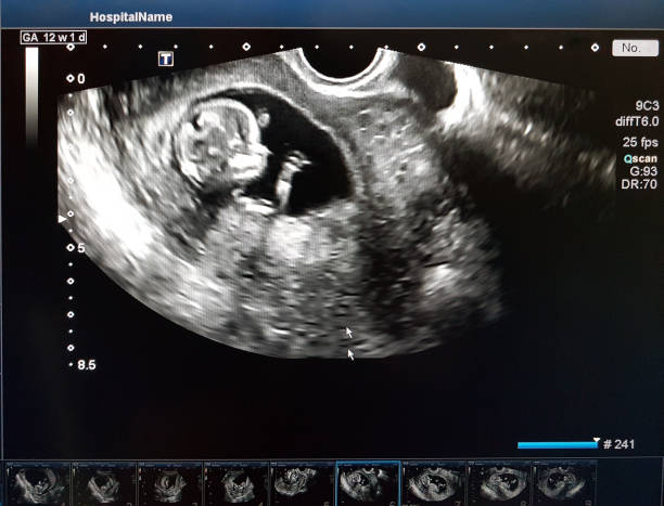 photos of the child in the 12 week of pregnancy. ultrasound procedure. screening in the first trimester. - ultrasound imagens e fotografias de stock
