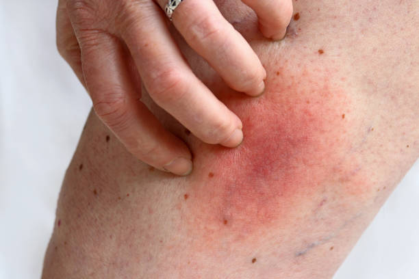 Allergic reaction to a bee sting on a woman's leg. Allergic rash Allergic reaction to a bee sting on a woman's leg. Allergic rash beesting cake stock pictures, royalty-free photos & images