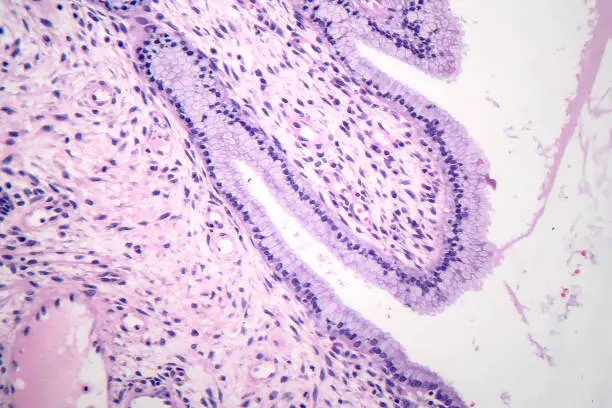 Histopathology of nasal polyps, light micrograph, photo under microscope