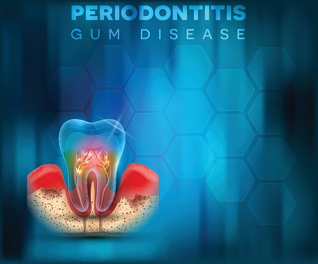 Periodontitis Gum Disease Poster Stock Illustration - Download Image