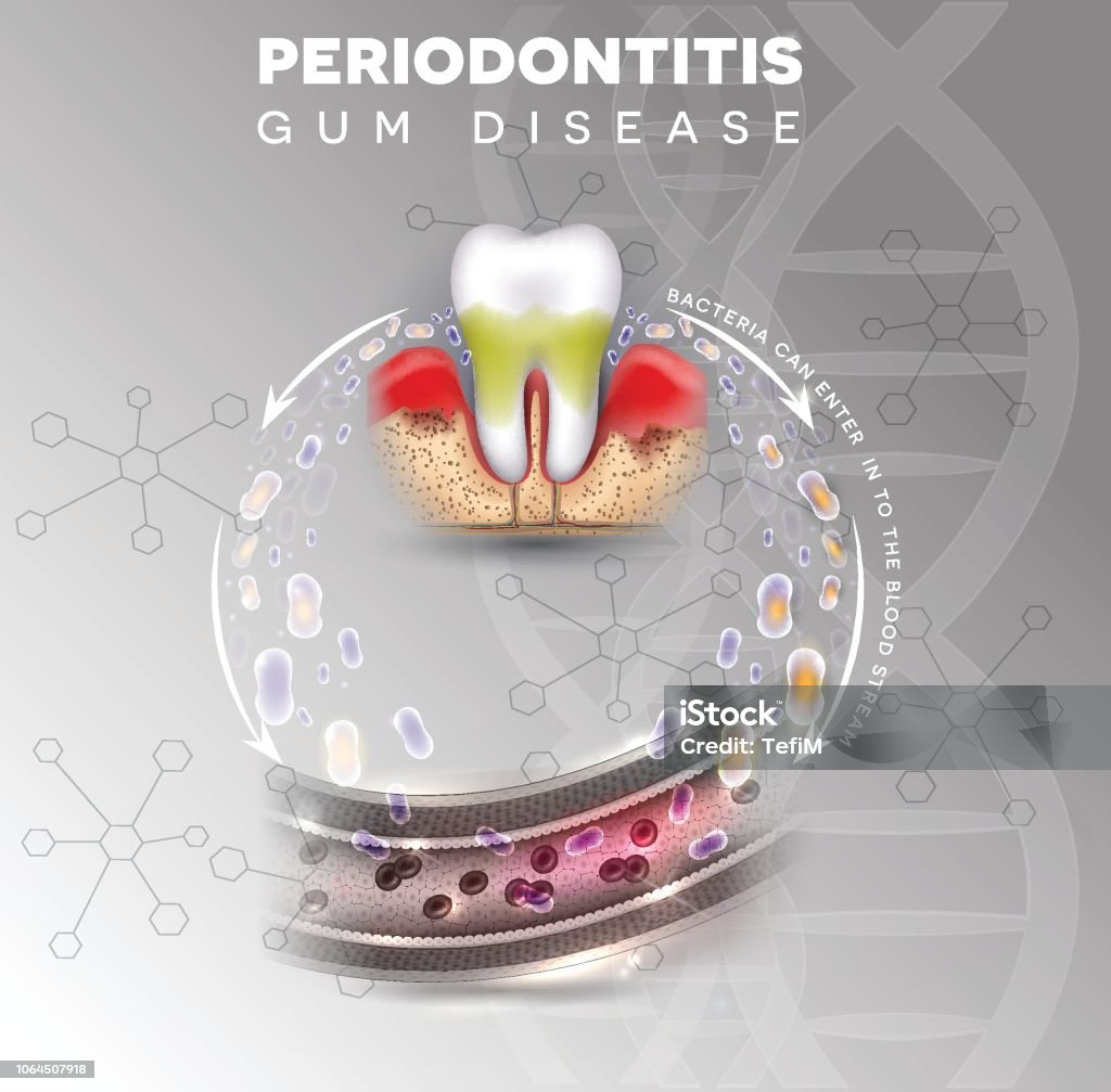 Periodontitis Complications Poster Stock Illustration - Download Image