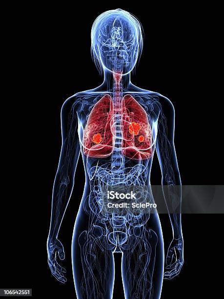 Foto de Câncer De Pulmão e mais fotos de stock de Anatomia - Anatomia, Azul, Câncer de Pulmão