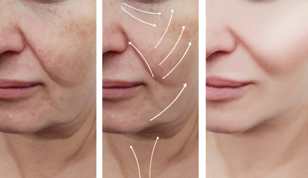 istock woman wrinkles face before and after correction procedures 1065561202