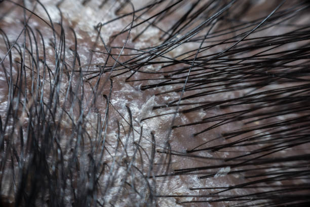 istock Hair scalp with dandruff and scaly from psoriasis 1065816420