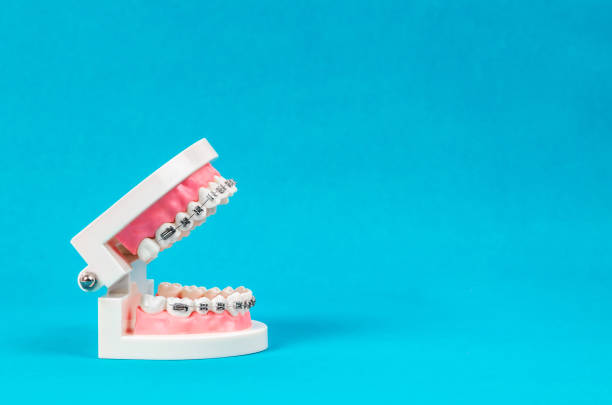 istock Tooth model with metal wire dental braces 1065824388